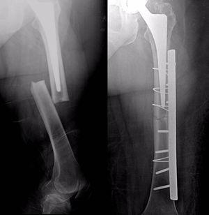 Fractura de femur